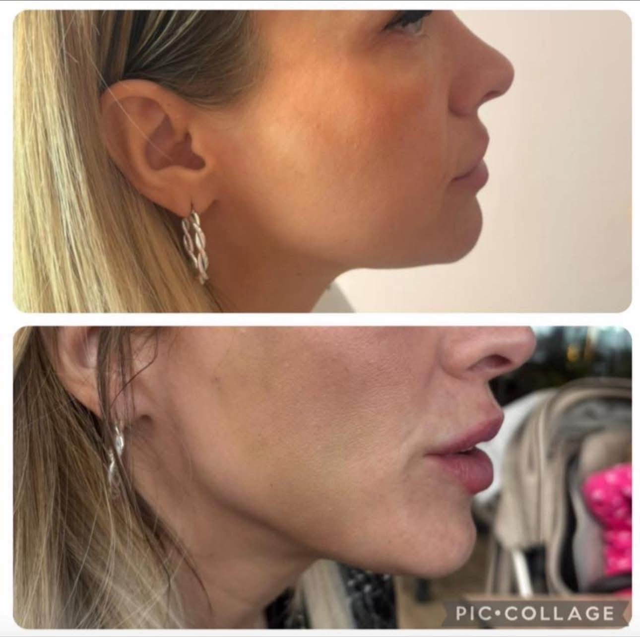 Endo-Fibre Lift