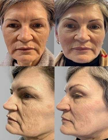Endo-Fibre Lift