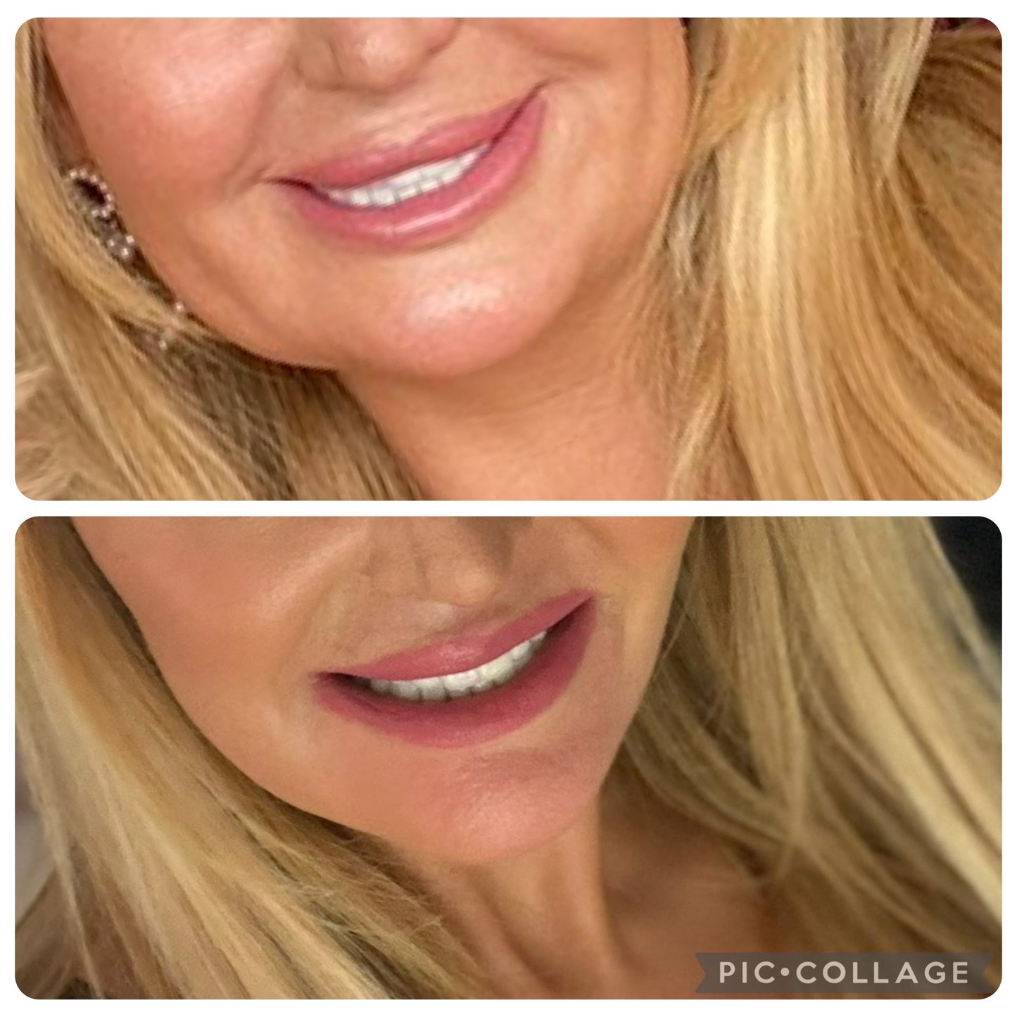 Endo-Fibre Lift