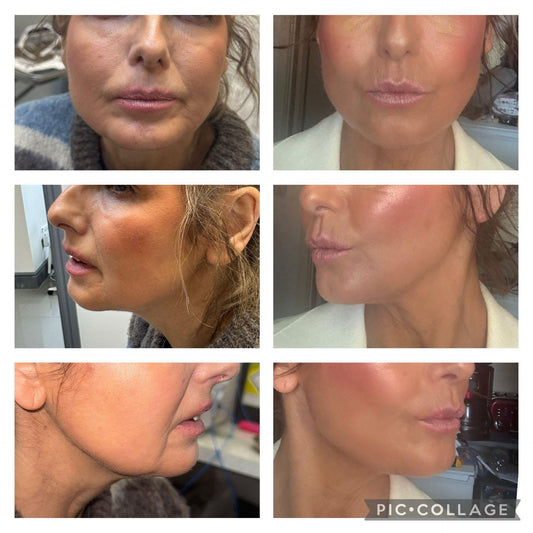Endo-Fibre Lift